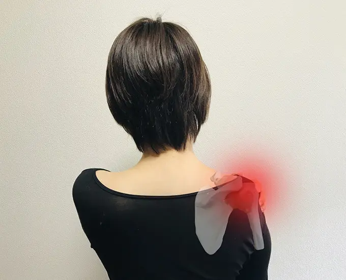 肩関節周囲炎のイメージ